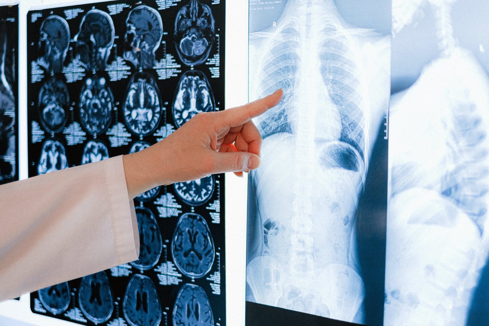 Zdjęcia rentgenowskie płuc i palec na nie wskazujący.