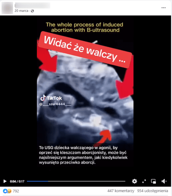 Zrzut ekranu z platformy Facebook, na którym widać nagranie z rzekomego badania USG, gdzie abortowane dziecko walczy o życie. Wideo nie jest prawdziwe. 